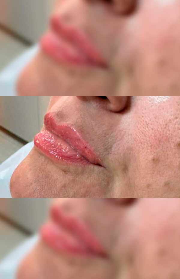 Antes e Depois Preenchimento Labial - Studio Una