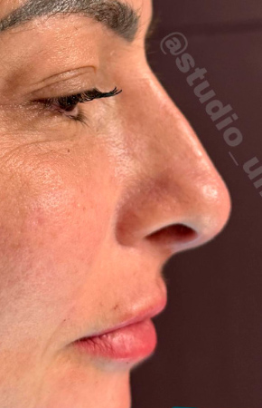 Antes e Depois Rinomodelação - Studio Una