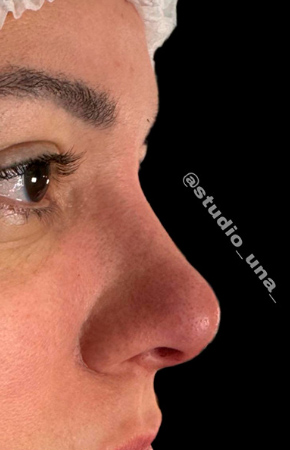 Antes e Depois Rinomodelação - Studio Una