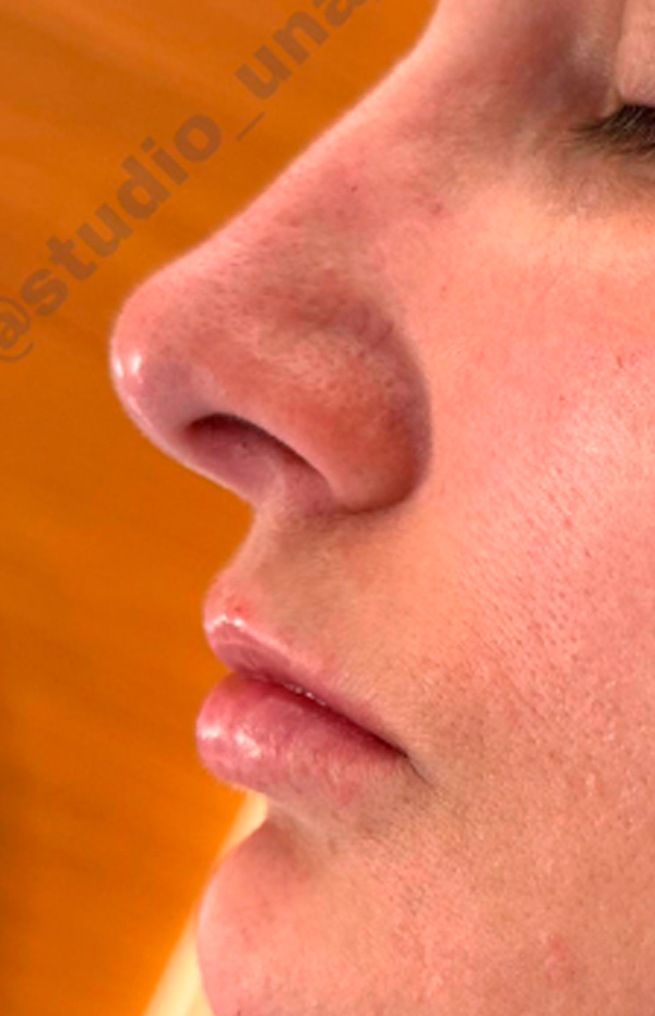 Antes e Depois Rinomodelação e Lábios - Studio Una