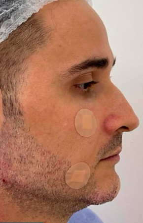 Antes e Depois Harmonização Facial - Studio Una