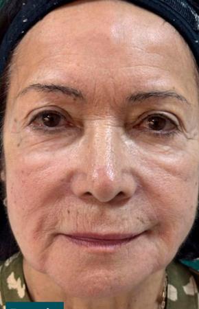 Antes e Depois Harmonização Facial - Studio Una