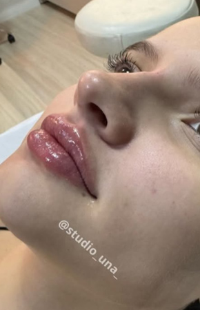 Antes e Depois Harmonização Facial - Studio Una