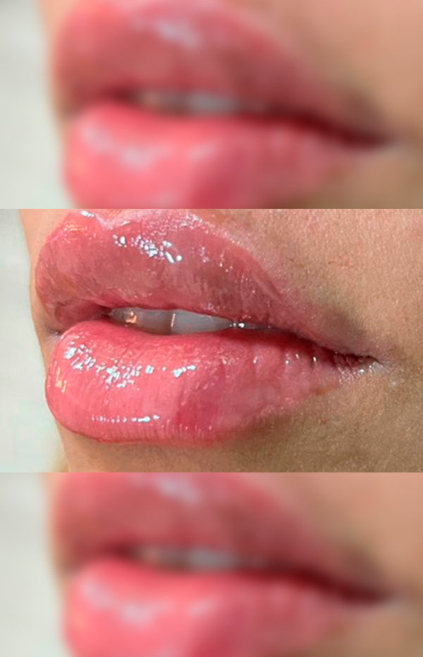 Antes e Depois Preenchimento Labial - Studio Una