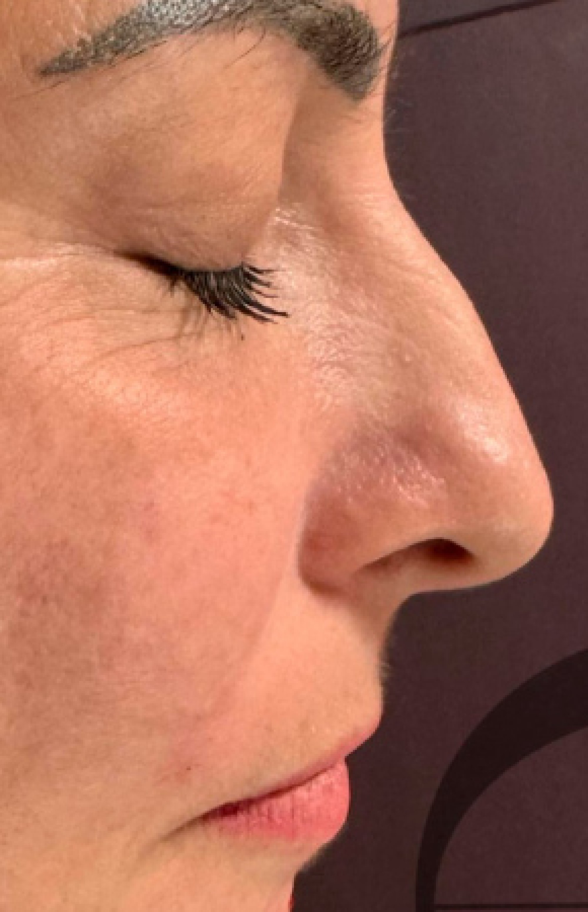 Antes e Depois Rinomodelação - Studio Una