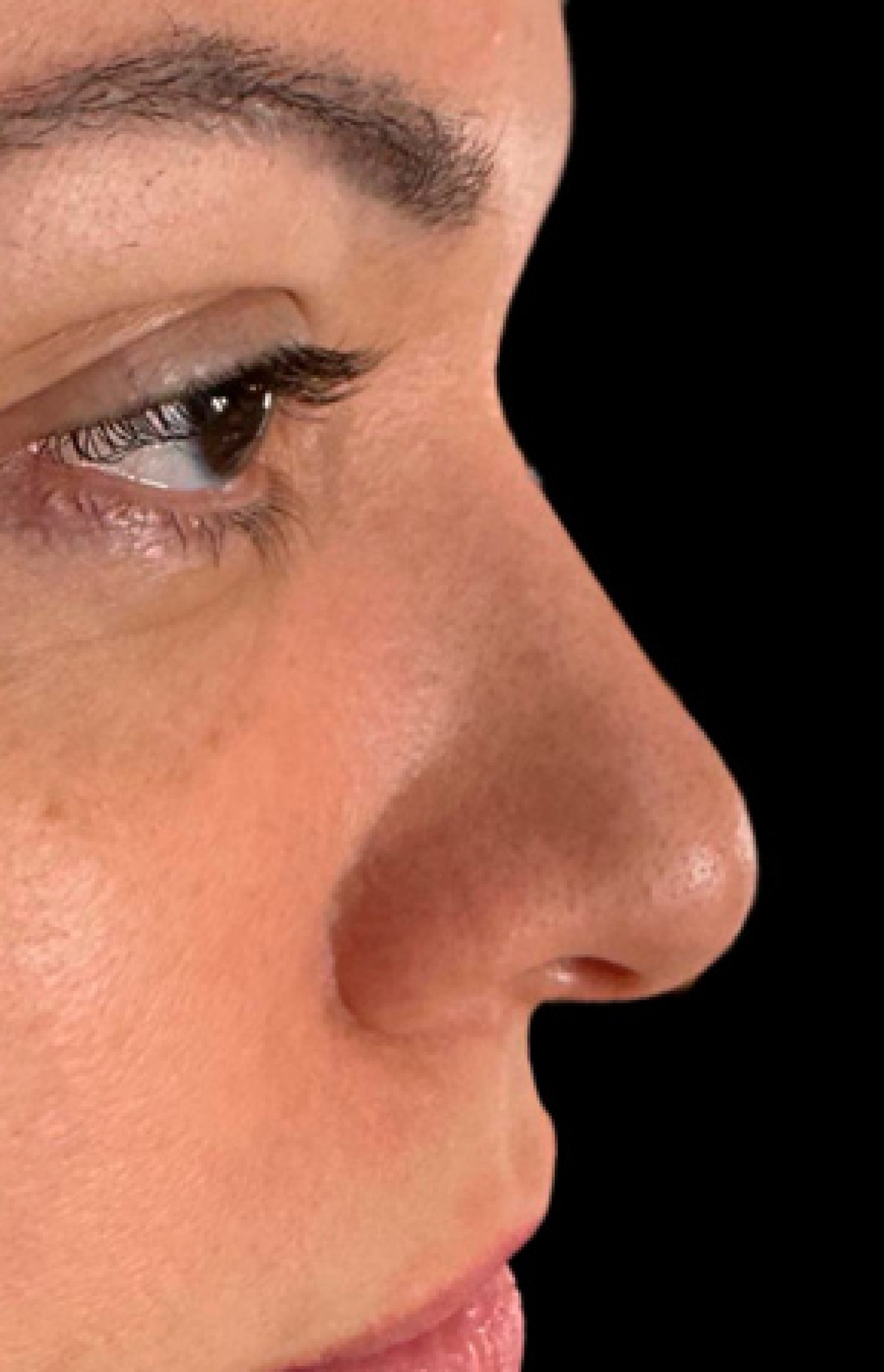 Antes e Depois Rinomodelação - Studio Una