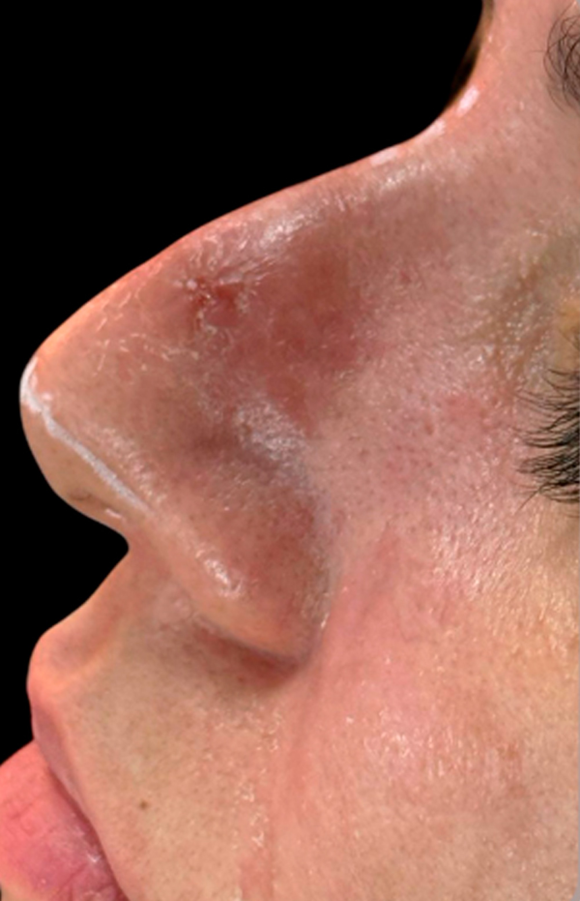 Antes e Depois Rinomodelação - Studio Una