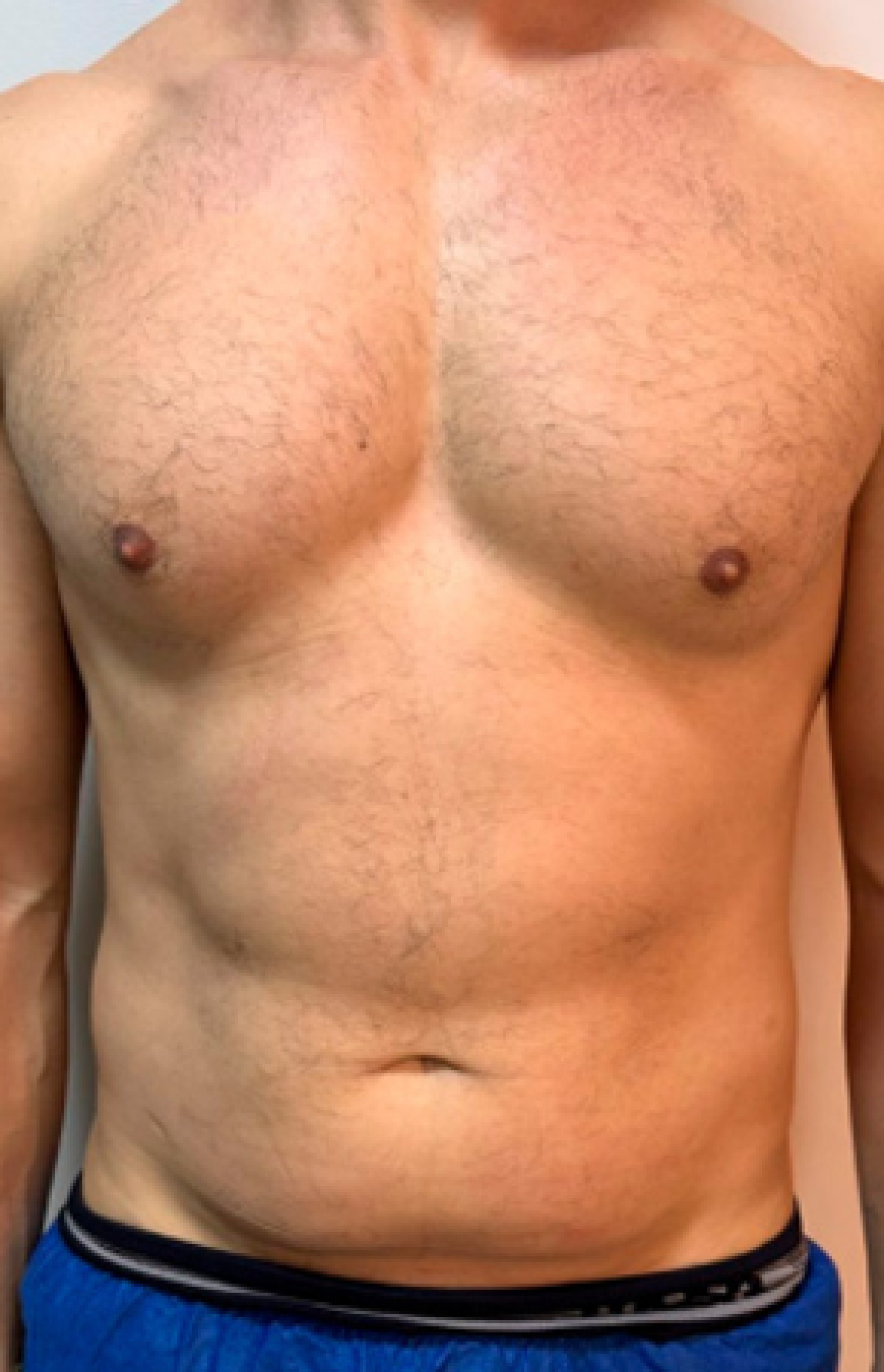 Antes e Depois Endolaser - Studio Una