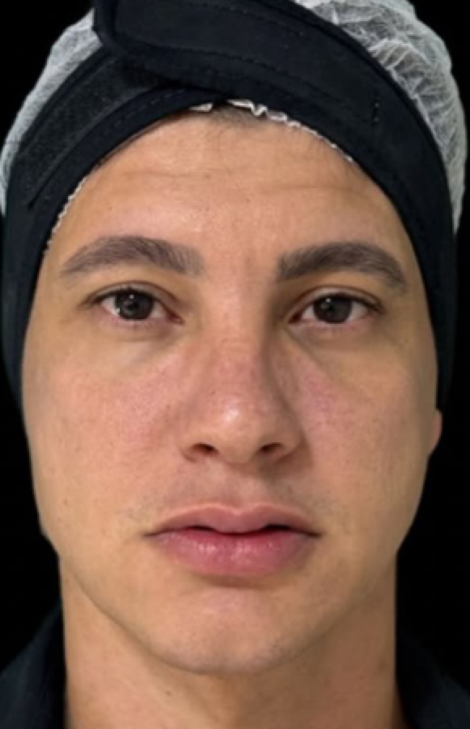 Antes e Depois Harmonização Facial - Studio Una