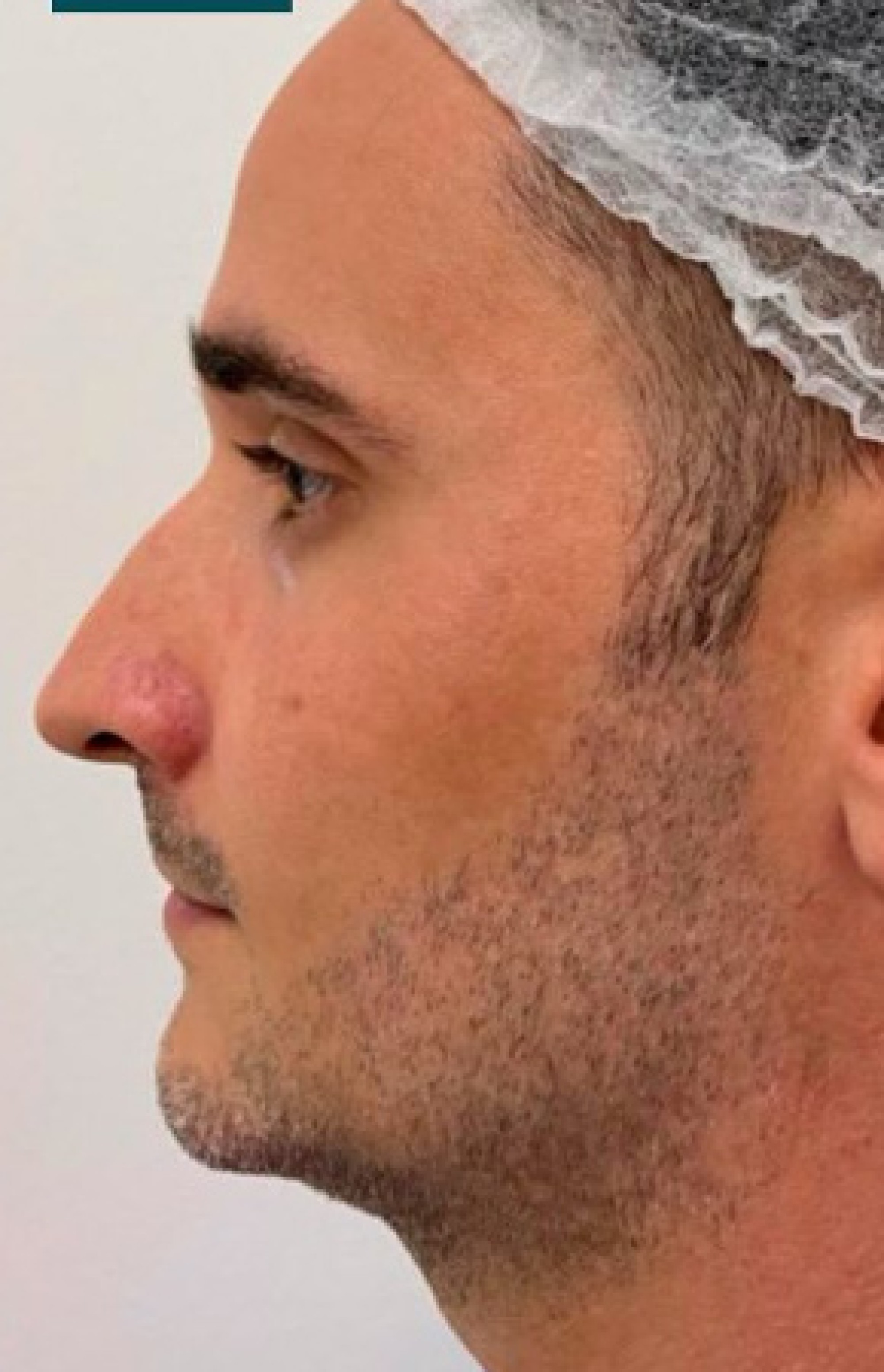 Antes e Depois Harmonização Facial - Studio Una