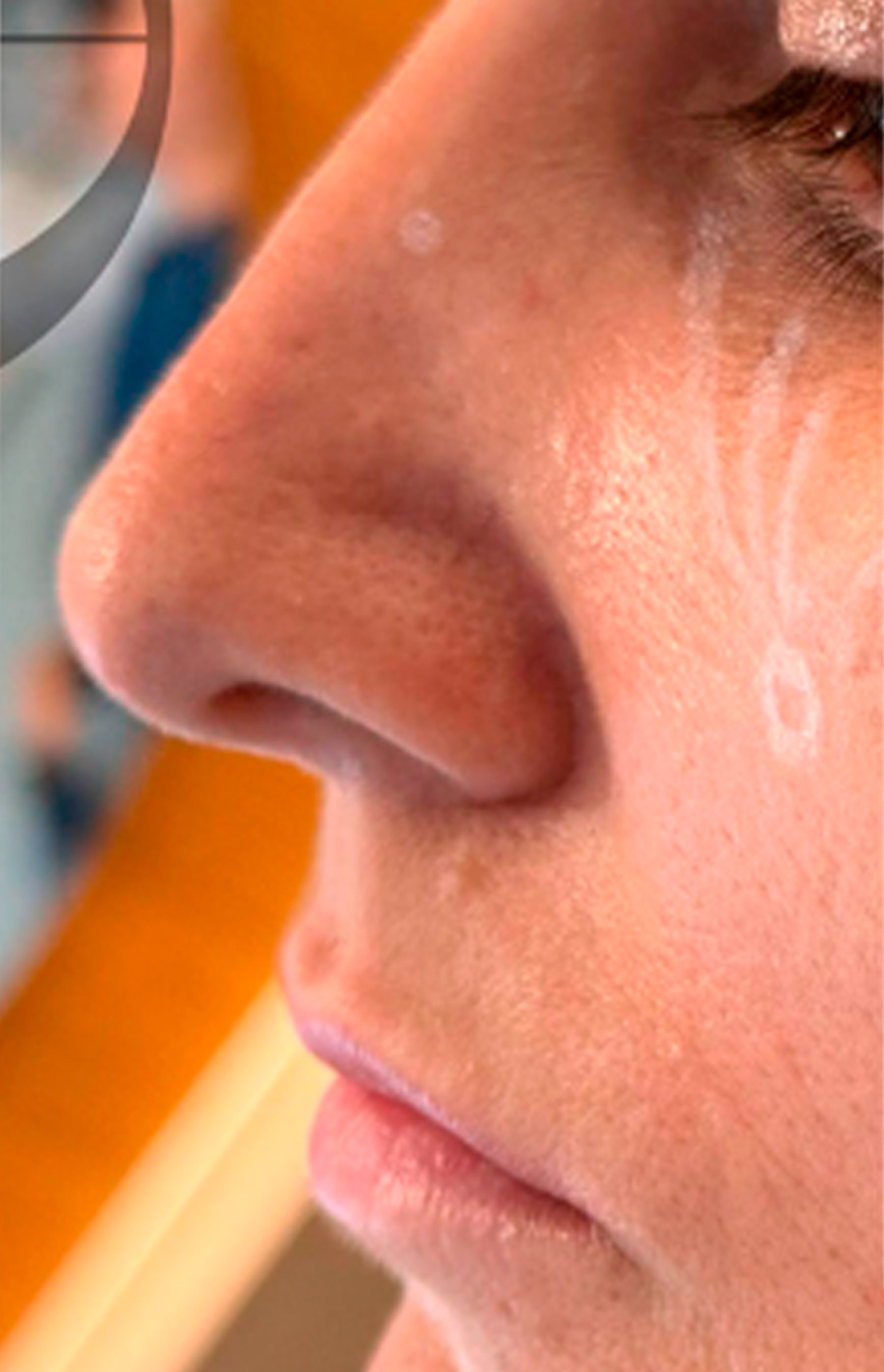 Antes e Depois Rinomodelação e Lábios - Studio Una