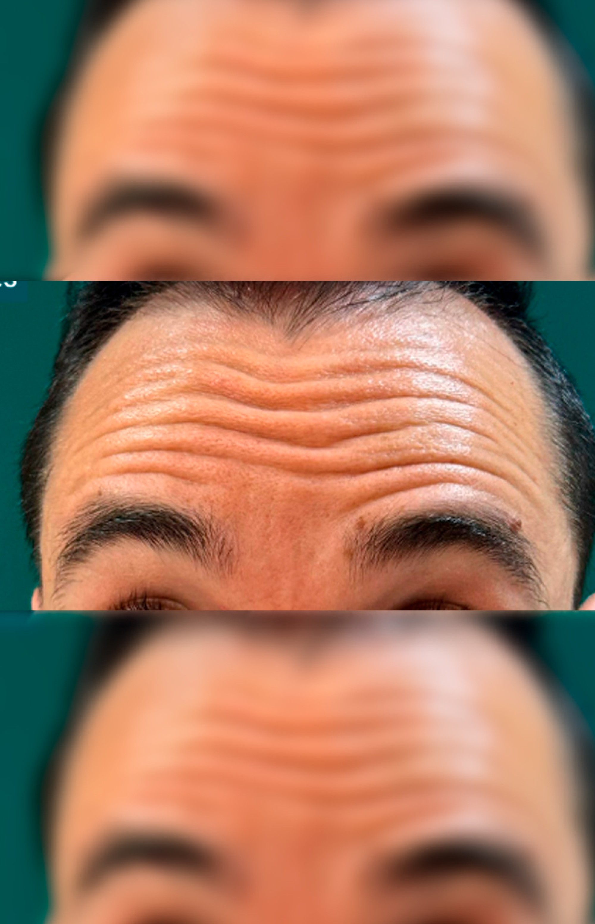 Antes e Depois Toxina Botulínica - Studio Una