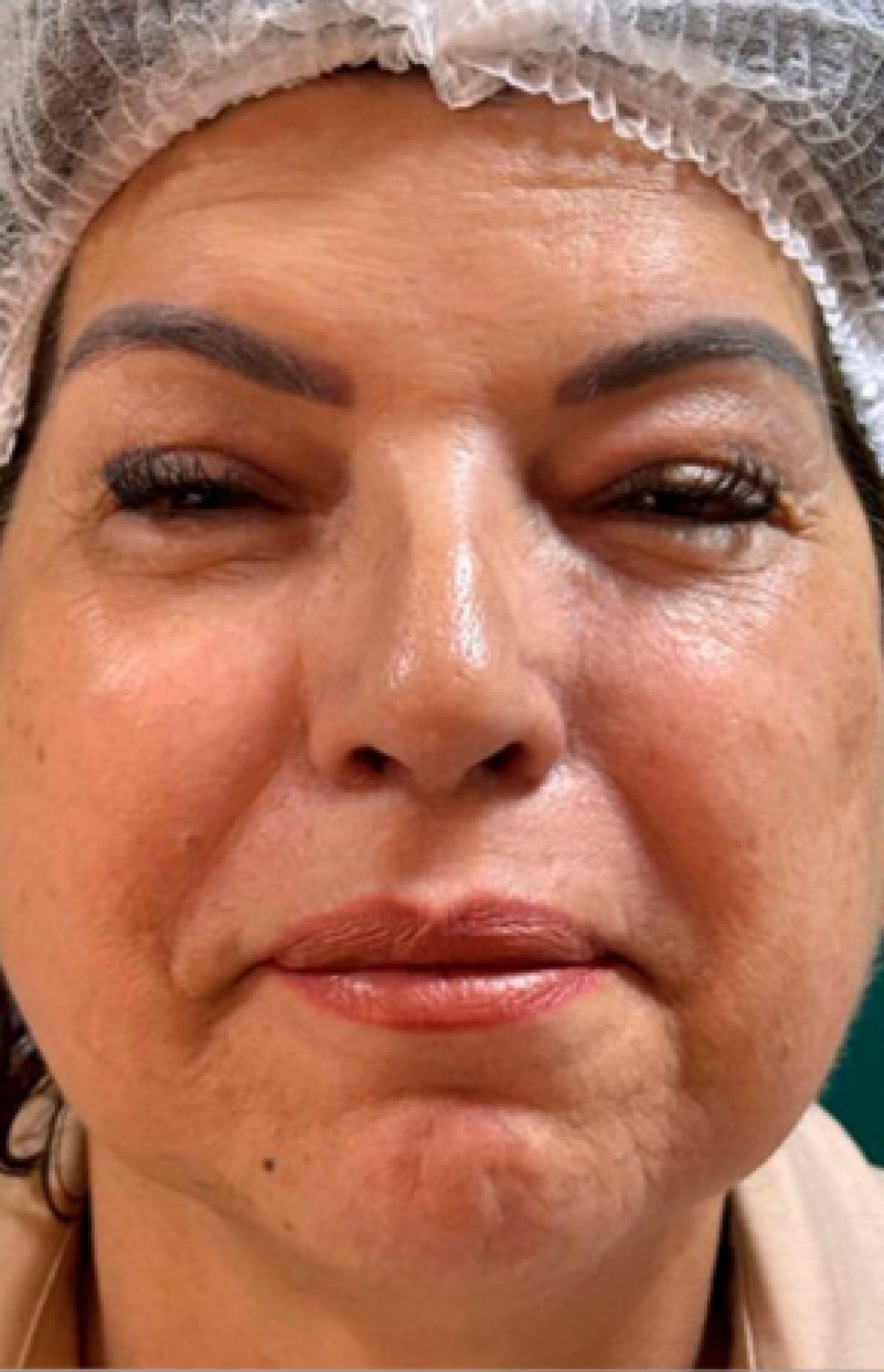 Antes e Depois Harmonização Facial - Studio Una