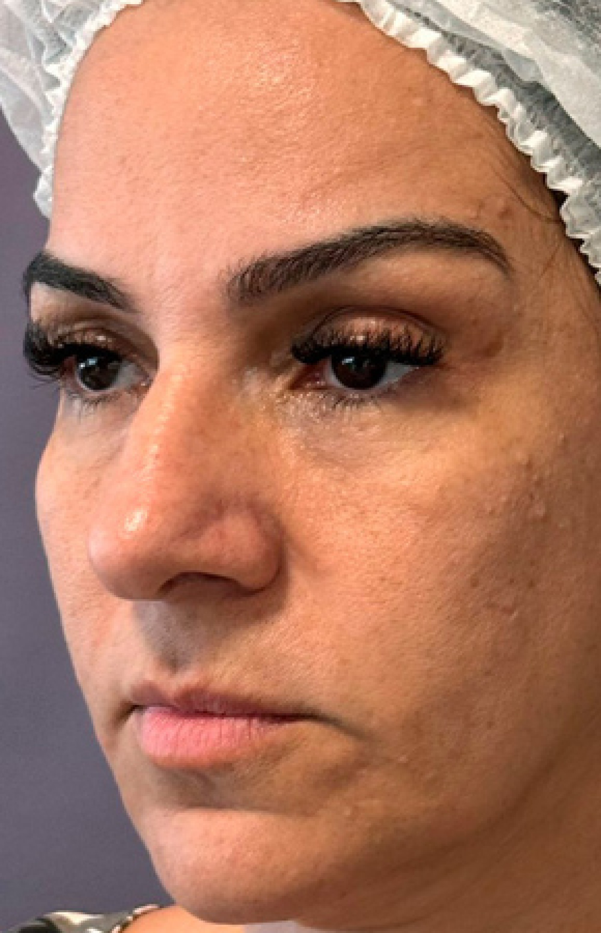 Antes e Depois Harmonização Facial - Studio Una