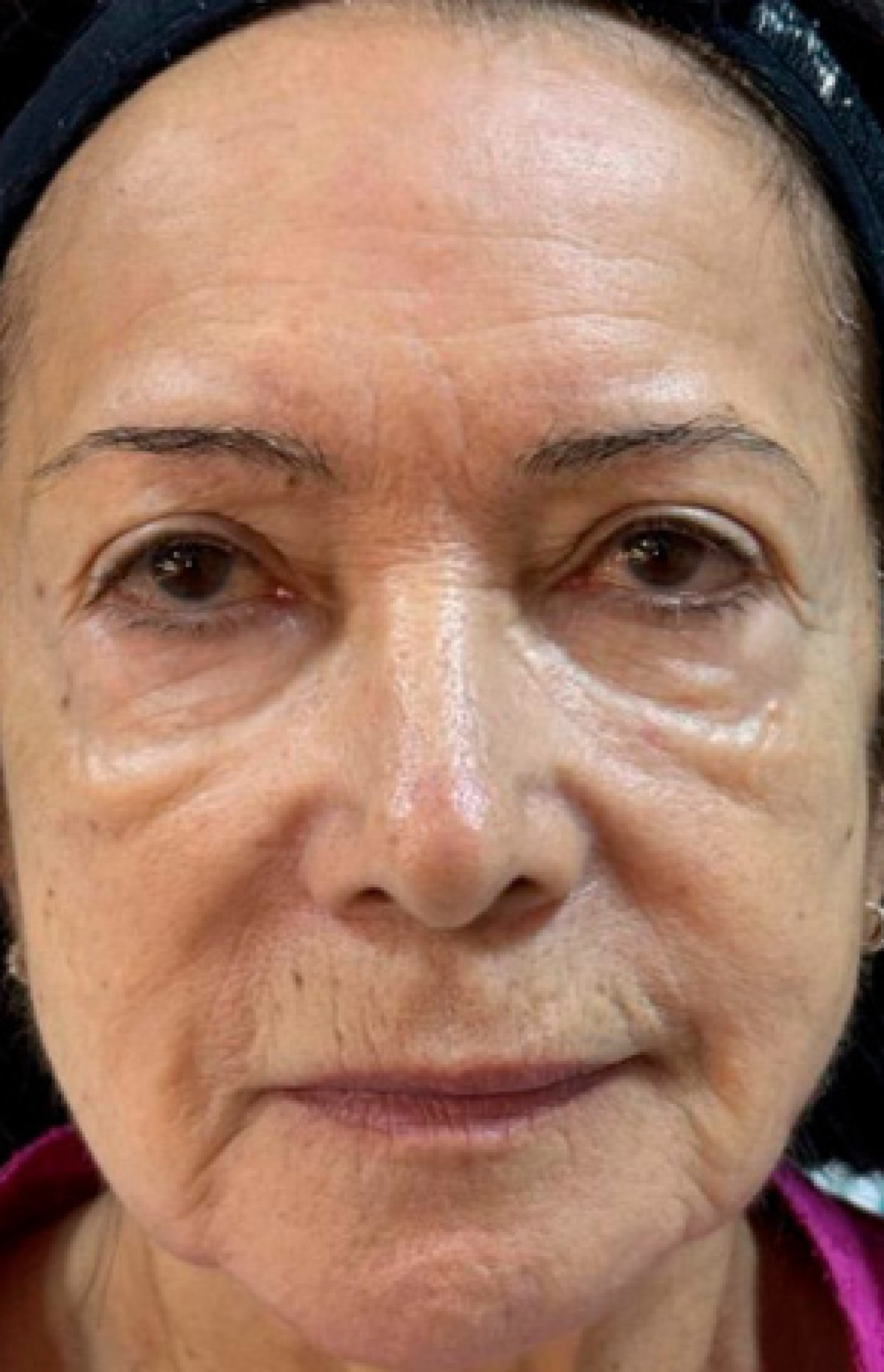 Antes e Depois Harmonização Facial - Studio Una