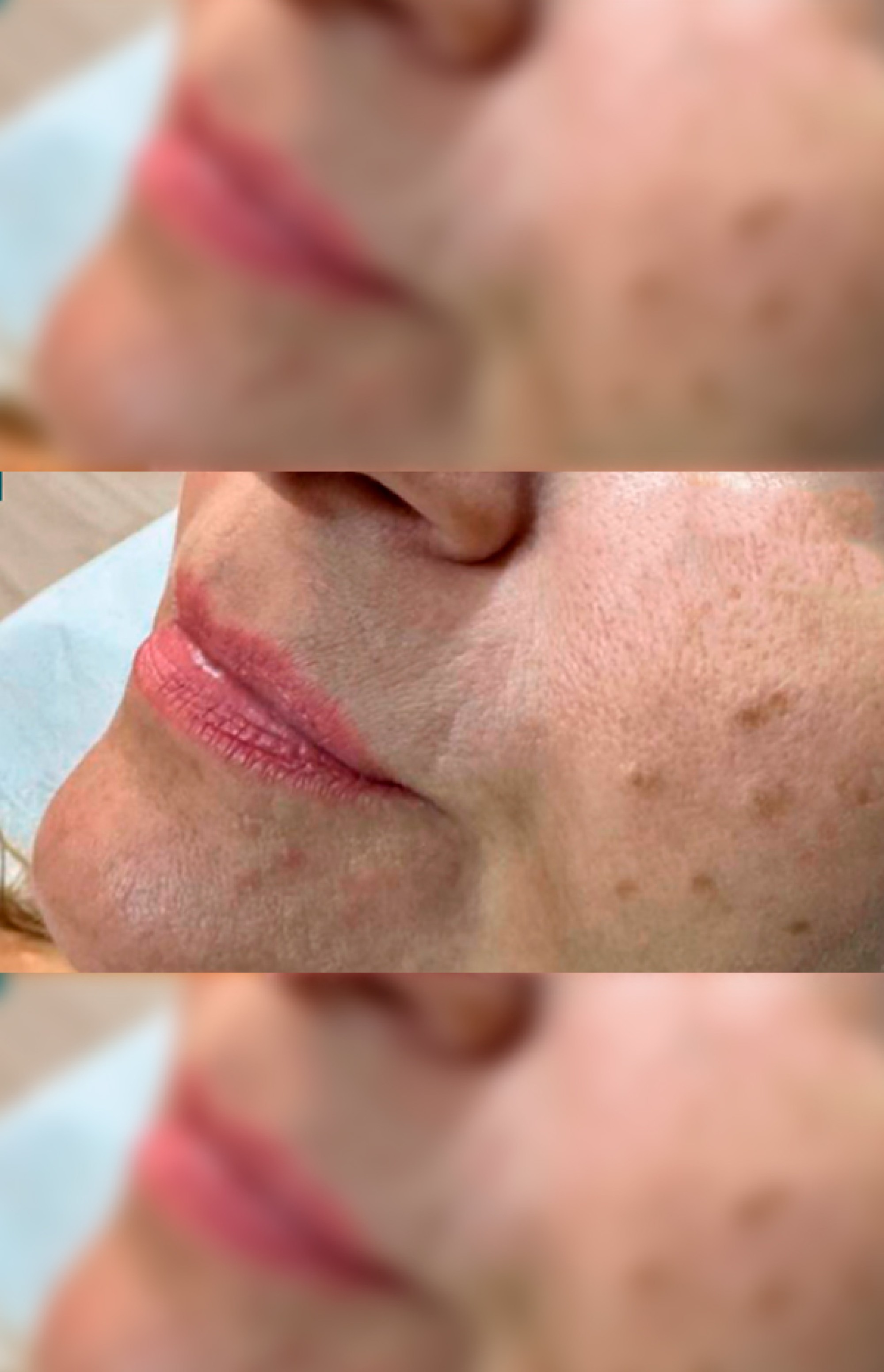 Antes e Depois Preenchimento Labial - Studio Una