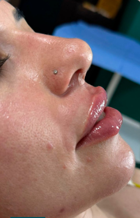 Antes e Depois Lábios, Rinomodelação e Mento - Studio Una