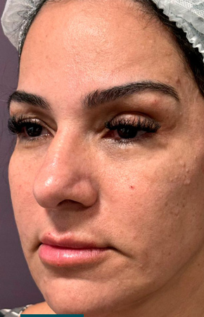 Antes e Depois Harmonização Facial - Studio Una